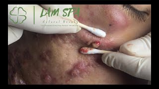 Treatment of acne pustules severe inflammation  MrL Part2  Điều trị mụn mủ viêm nặng  LAMSPA [upl. by Ydennek]