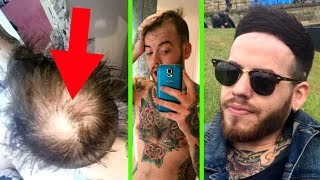 HIDING HAIR LOSS FOR 5 YEARS  How I BEAT BALDING  Baldcafe Podcast 25 [upl. by Ennail]