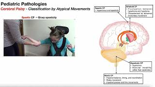 Cerebral Palsy Overview 🧠 Introduction amp Classifications [upl. by Campney]