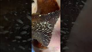 Blackheads Removal  Acne Treatment and Very Satisfying Satisfying Pimple pop blackheads [upl. by Ailegna]