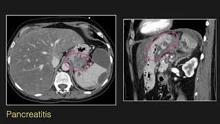 Abdominal Radiology Lecture CT of Esophageal and Gastric Pathology [upl. by Seely49]