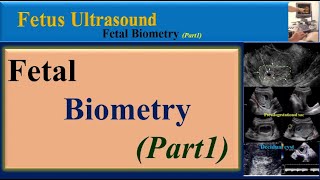 Fetus Ultrasound Fetal BiometryPart1 [upl. by Seroka]