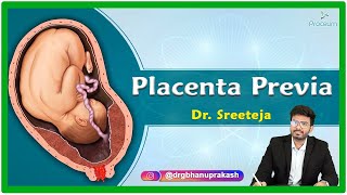 Placenta Previa Etiology Pathophysiology Clinical presentation Diagnosis and Treatment [upl. by Atiken]