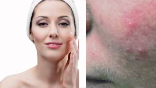 Best Rosacea Cream  Behandlung Rosacea  Goodbye Rosacea Forever [upl. by Anitselec5]