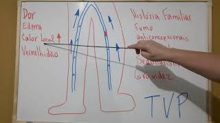 Trombose venosa profunda TVP [upl. by Deborath]