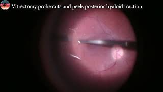 Vitrectomy Surgery for Vitreomacular Traction Syndrome [upl. by Tuddor]