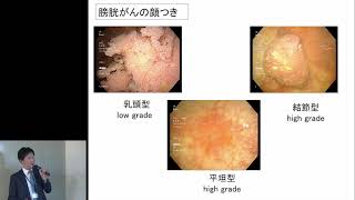 膀胱がん「講義」上川 禎則 先生（大阪市立総合医療センター 泌尿器科）【大阪オンコロジーセミナー Meeting the Cancer Experts 第7回】 [upl. by Tareyn]