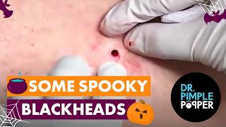 Some Spooky Blackheads [upl. by Thursby]