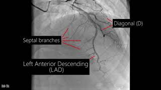 Coronary artery anatomy  Coronary angiogram [upl. by Peers]