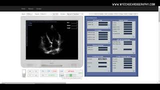 Ejection Fraction EF [upl. by Ccasi633]