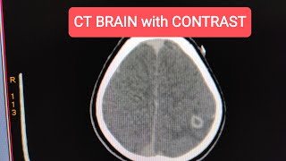 Neurocysticercosis NCC CT Scan Brain with Contrast [upl. by Orelia]