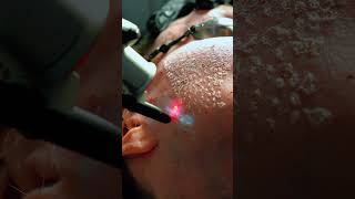 Watch this skin contract with an ablative CO2 Laser Treatment [upl. by Ydnak]