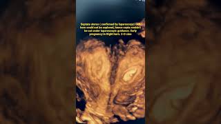 Septate uterus Left horn could not be explored Early pregnancy in Right horn 3D cine [upl. by Wiltsey173]