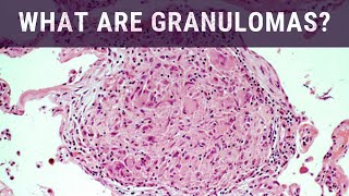 What are Granulomas  Pathology mini tutorial [upl. by Constance619]