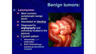 Small Intestine Cancer Symptoms Causes and Treatment  General Surgery Lecture [upl. by Heisel]