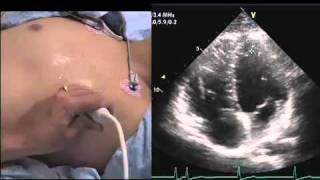 Intro to Echo Apical 4 Chamber Viewmov [upl. by Anneres]