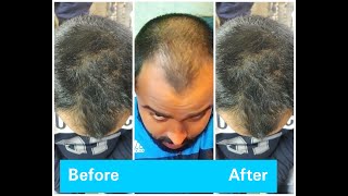 23 days results of hair regrowth Hair growBest oil for regrowthPatient feedbackleech therapy [upl. by Hermann169]