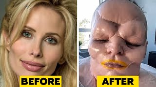 15 Times Plastic Surgery Went Horribly Wrong [upl. by Olympie]