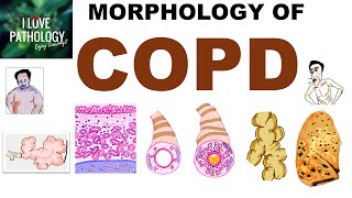 COPD Morphology Review  Emphysema Chronic Bronchitis Bronchiectasis Asthma  Exam Prep [upl. by Dor793]