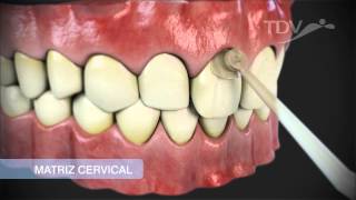 MATRIZ CERVICAL TDV  Restauraciones de Clase V [upl. by Ertha560]