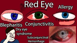 Toddler Pink Eye Conjunctivitis [upl. by Trebornhoj]