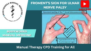 Froments Sign for Ulnar Nerve Palsy [upl. by Matty]