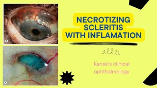 Necrotizing scleritisKanskis clinical ophthalmology sclera ophthalmology kanski medical [upl. by Arnelle]