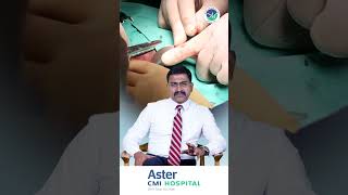 Treatment for Haemorrhoids  Dr Mahesh Chikkachannappa  Aster CMI Hospital [upl. by Aicirtap]