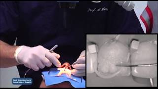 IPS Empress Direct StepbyStep with Prof Antonio Cerutti [upl. by Fennie]