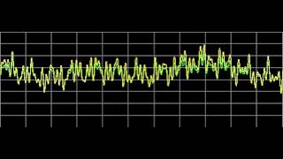 Multiple Myeloma  Rife Frequencies [upl. by Leyla]