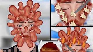 ASMR Removal Big Acne amp Maggot infected from face  ASMR Animation Treatment restasmr1 [upl. by Duster490]