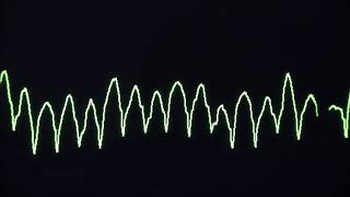 Cardiac arrest rhythms VF VT Asystole and PEA [upl. by Htedirem]