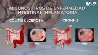 ¿Cómo tratar las enfermedades inflamatorias del intestino  ExclusivoMSP [upl. by Isdnil]