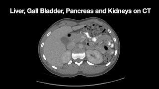 Anatomy of the Liver Gall Bladder Pancreas and Kidneys on CT [upl. by Gyasi]