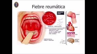 Antiestreptolisina O ASTO [upl. by Mariano122]