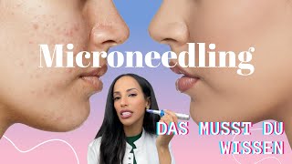 Microneedling  ALLES WAS DU WISSEN MUSST [upl. by Gerdi]