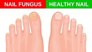 Simple Home Remedies for Toenail Fungus [upl. by Jemima]