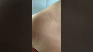 Pityriasis Rosea  Sanjeevani Skin Clinic India [upl. by Loralee]