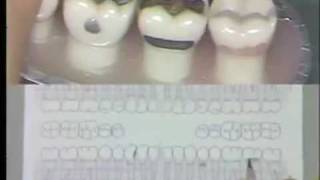 Dental Charting Procedures [upl. by Lluj]