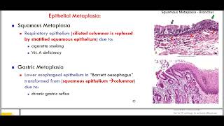 hypertrophy metaplasia [upl. by Barb]