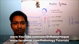 Marfan Syndrome  Part 1 HD [upl. by Einttirb]