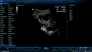 Dichorionic twins and two corpus luteum cysts Diagnostic ultrasound cases [upl. by Tneicniv]