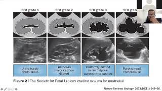 Ecografía renal y de vías urinarias [upl. by Aned]