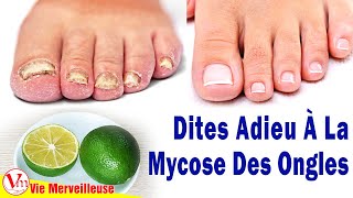 Comment Enlever Les Mycoses Des Ongles Des Pieds Rapidement Avec Du Citron Et De L’huile D’olive [upl. by Shig]