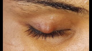 Chalazion Incision amp Curettage HD [upl. by Warenne]