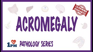 Acromegaly  Pathophysiology Symptoms Diagnosis Treatment [upl. by Koziarz]