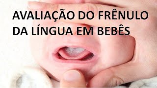 AVALIAÇÃO DO FRÊNULO DA LÍNGUA EM BEBÊS [upl. by Mariya500]