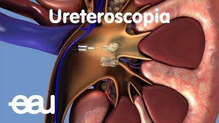 Tratamiento de cálculos renales y ureterales URS [upl. by Perrin623]