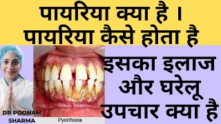 पायरिया क्या है  पायरिया कैसे होता है  पायरिया का इलाज और घरेलु उपचार  Treatment Of Pyorrhea [upl. by Animor398]