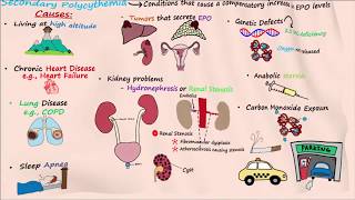 Polycythemia  Part 2 [upl. by Cristabel]